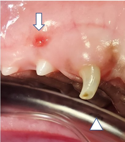 fractured deciduous tooth in the late stage of infection. The white arrow points to the tract that pus takes to drain from the side of the face. The white arrowhead shows the fractured tooth tip. 